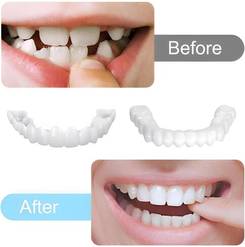 2 Pairs of Adjustable Smile Supports (Upper and Lower Suits) Can Adjust Comfort to Quickly Restore Confident Smiles in Saudi Arabia