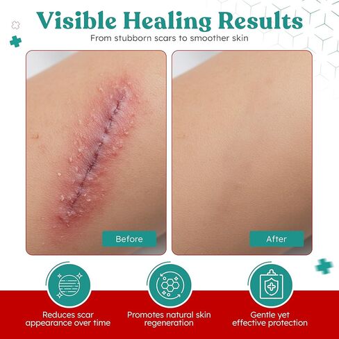 Medical Grade Hydrocolloid Roll 2in × 5ft – Flexible & Waterproof Hydrocolloid Bandages | Cut-to-Size Hydrocolloid Dressing Tape, Pimple Patch Roll & Adhesive Bandages in Saudi Arabia