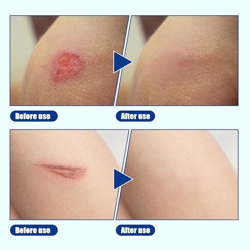 لفة غرواني مائي مقاس 2 بوصة × 5 أقدام، ضمادات للعناية بالجروح مقاومة للماء، ضمادات نفطة للأقدام، بقع حب الشباب، رقع غرواني مائي مرنة وخالية من اللاتكس in Kuwait