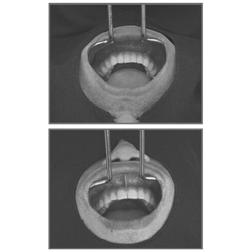 ضام الشفاه من أوسونغ لطب الأسنان - RTCRL in Kuwait