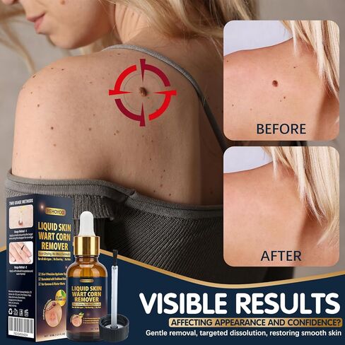 Skin Tag Remover & Wart Remover Liquid 30ml, Liquid Skin Wart & Corn Remover with Precision Applicator, Fast-Drying Plant Formula for Common & Plantar Warts, Skin Tag and Corn Care for All Skin Types in Kuwait
