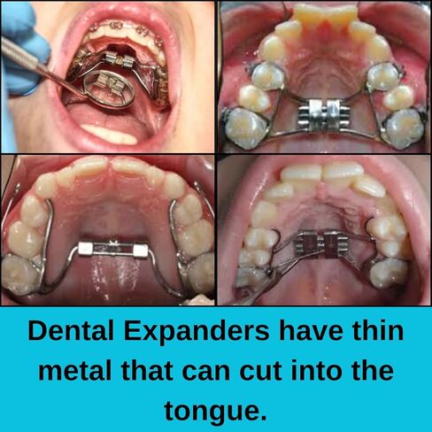 RPE Tongue Guard: Prevents and Helps Heal Tongue Sores Caused by Dental Expanders | Tongue Sores | Metal Cuts | Dental Ortho Braces | in Saudi Arabia
