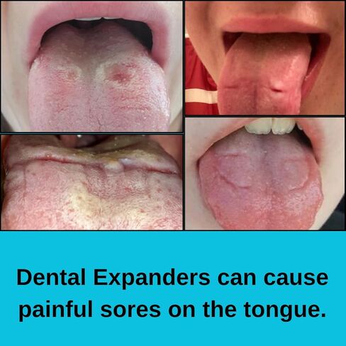 RPE Tongue Guard: Prevents and Helps Heal Tongue Sores Caused by Dental Expanders | Tongue Sores | Metal Cuts | Dental Ortho Braces | in Saudi Arabia