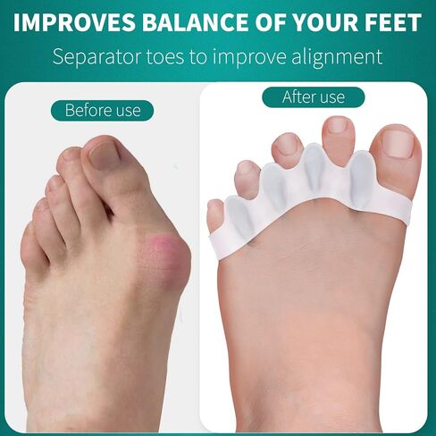 Pack of 10 Toe Separator, Silicone Toe Spacers for Correct Toe Alignment, Toe Spreader for Bunions Correct, Restore Overlapping Toes to Original Shape(Size: XL) in Saudi Arabia