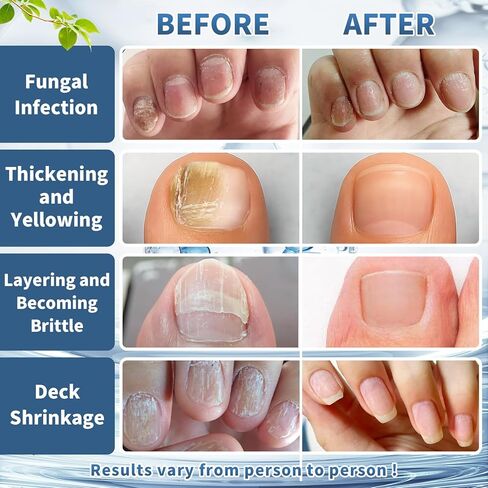 Toenail Fungus Treatment Extra Strength - Fast Acting Nail FungusTreatment for Finger & Toe Nails - Restore and Repair Damaged & Discolored Nails in Saudi Arabia