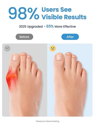Bunion Corrector for Women and Men - Podiatrist Recommended, Toe Straightener for the Thumb and Little Toe, Foot Alignment and Pain Relief(1 Pair) in Saudi Arabia