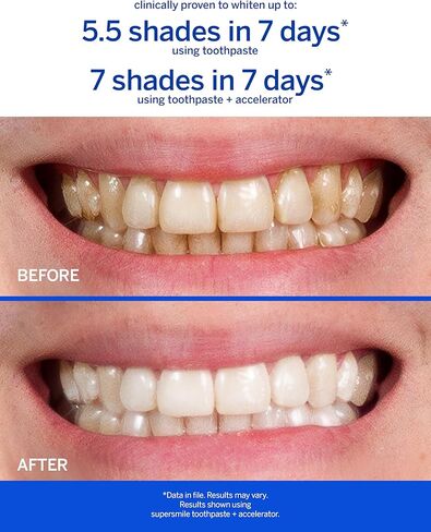 Supersmile Fluoride-Free Whitening System – 1.4oz Professional Grade Whitening Toothpaste & 1.2oz Accelerator – Whitens up to 6 Shades & Strengthens Enamel in Kuwait