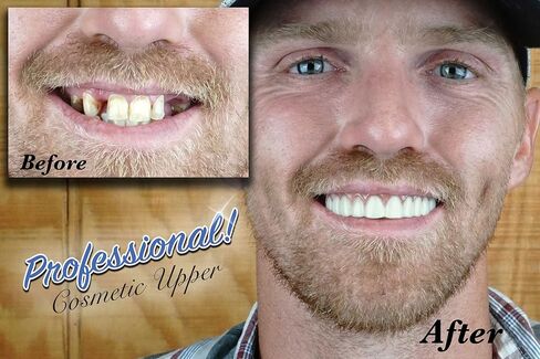 Professional Cosmetic Upper - New from Instant Smile! Hand Crafted Detail, Custom fit at Home! Works Best in Medium to Large Sized Mouths. in Kuwait