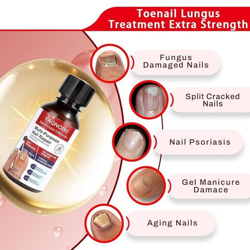 Toenail Fungus Treatment - Fast Acting For Thick, Discolored, Broken & Damaged Toe & Finger Nail, Treats Damaged Nails and Ingrown Toenails - 30ml/1oz (1pcs) in Saudi Arabia