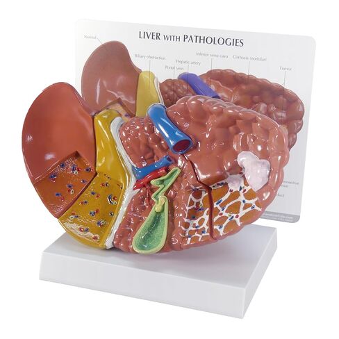 GPI Anatomicals - نموذج الكبد مع الأمراض الشائعة، نسخة طبق الأصل لتعليم التشريح البشري وعلم وظائف الأعضاء، نموذج التشريح لمكاتب الأطباء والفصول الدراسية، مصادر التعلم الطبي in Kuwait