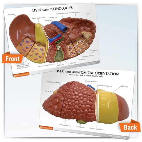 GPI Anatomicals - نموذج الكبد مع الأمراض الشائعة، نسخة طبق الأصل لتعليم التشريح البشري وعلم وظائف الأعضاء، نموذج التشريح لمكاتب الأطباء والفصول الدراسية، مصادر التعلم الطبي in Kuwait