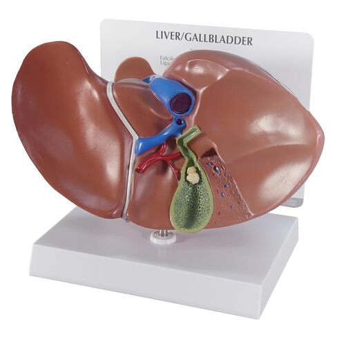 GPI Anatomicals - نموذج الكبد مع الأمراض الشائعة، نسخة طبق الأصل لتعليم التشريح البشري وعلم وظائف الأعضاء، نموذج التشريح لمكاتب الأطباء والفصول الدراسية، مصادر التعلم الطبي in Kuwait