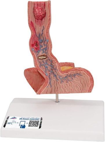 3B Scientific K18 Illnesses of the Esophagus - 3B Smart Anatomy in Saudi Arabia