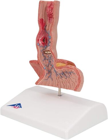 3B Scientific K18 Illnesses of the Esophagus - 3B Smart Anatomy in Saudi Arabia