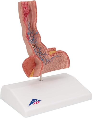 3B Scientific K18 Illnesses of the Esophagus - 3B Smart Anatomy in Saudi Arabia