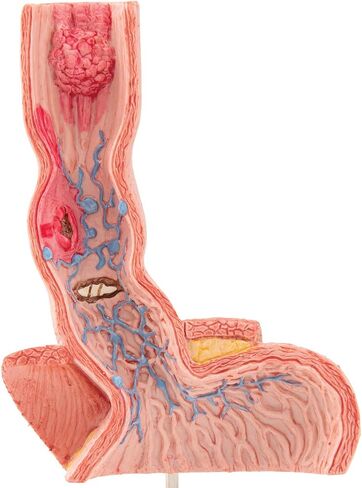 3B Scientific K18 Illnesses of the Esophagus - 3B Smart Anatomy in Saudi Arabia
