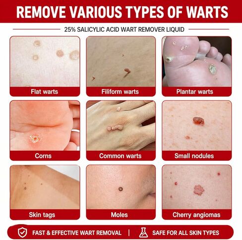 20% Salicylic Acid Wart Remover Liquid, Zero Pain Wart Remover for Plantar, Common, Flat Wart, Foot Corn for Multiple Parts of Body (Pack of 1) in Saudi Arabia