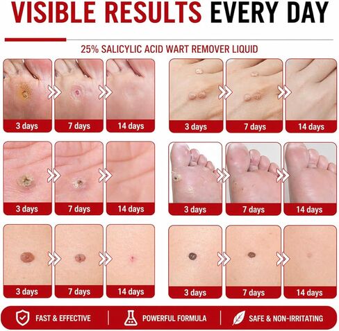 20% Salicylic Acid Wart Remover Liquid, Zero Pain Wart Remover for Plantar, Common, Flat Wart, Foot Corn for Multiple Parts of Body (Pack of 1) in Saudi Arabia