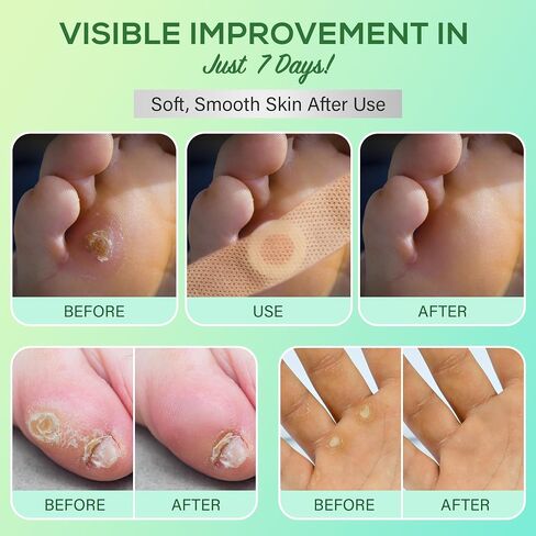 SupreH Corn Removers for Toes Feet Bandages: Corn Cushions and Small Callus Removal with 40% Salicylic Acid Long Adhesive - for Adult Seniors Nurses Hikers Athletes Men Women Pads 22 P in Kuwait
