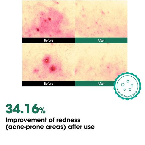 SOME BY MI AHA BHA PHA 30 Days Miracle Body Toner Mist – 4.73oz, 140ml – Body Acne Spray for Back & Chest, Exfoliating Body Mist with Salicylic Acid, Tea Tree, Niacinamide – Korean Skincare in Saudi Arabia