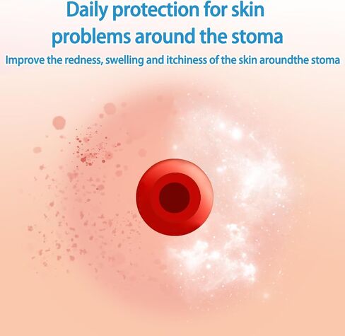 Stoma Powder, 1 oz (30g) Medical Colostomy Skin Barrier Powder, Protective Ostomy Care Supplies Powder for Ileostomy Urostomy, Relief for CGM Glucose Monitor Adhesive Patch Skin Irritation in Saudi Arabia