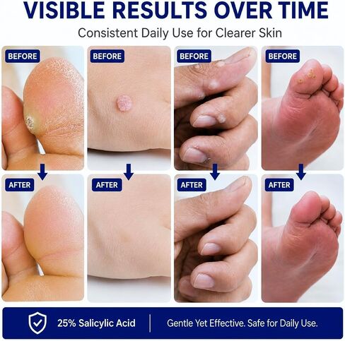 سائل مزيل الثآليل بحمض الساليسيليك بنسبة 25%، نتائج مرئية خلال 7 أيام، علاج قوي للغاية للثآليل الشائعة والأخمصية، سريع المفعول، فرشاة توزيع دقيقة، 30 مل in Kuwait