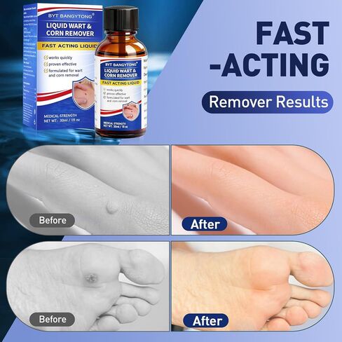 Wart Remover Liquid - Gentle Formula for Plantar Warts, Common & Corn on Feet, Hands and Other External Areas - 17% Salicylic Acid - NET WT: 30ml/ 1fl oz in Kuwait