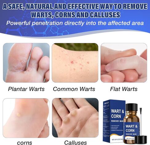 Mitreal Wart Remover Liquid with Salicylic Acid for Feet and Hands, Plantar Wart and Corn Remover Freeze Off Formula, Fast Acting Treatment for Common Flat Warts, Corns and Calluses 15 ml (0.5 fl oz) in Saudi Arabia