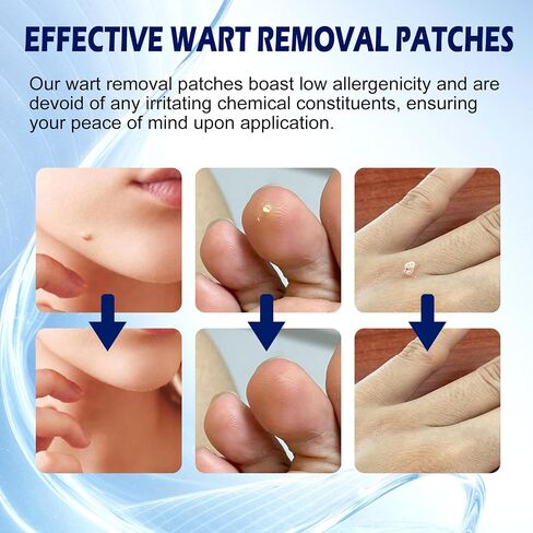 Maximum Strength Salicylic Acid Wart Remover Patches, 180 Count, Hydrocolloid Waterproof Invisible Stickers, Easy-to-Use Targeted Care for Plantar and Common Warts-1 Pack in Kuwait