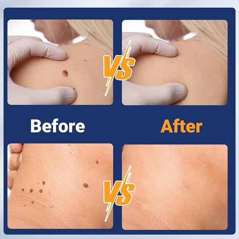 Komxsum Wart Remover Patches, Removes Warts from Various Parts of The Body,Fast Acting,Safe and Easy to Use(180PCS) in Kuwait