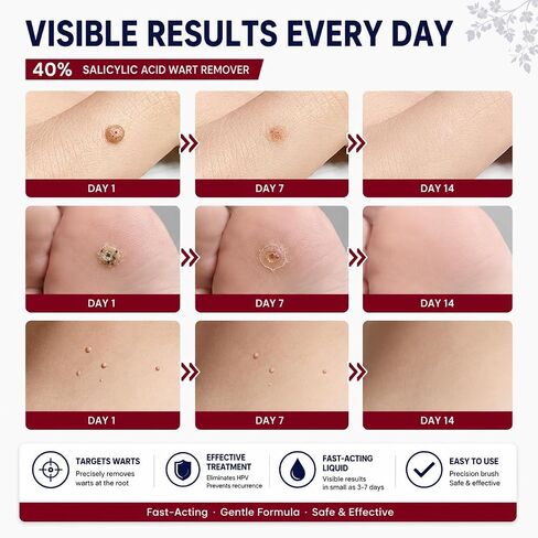 سائل مزيل الثآليل بحمض الساليسيليك بنسبة 40% للقدمين والجسم، مزيل الثآليل الأخمصية بقوة قصوى للقدمين، مزيل الثآليل سريع المفعول للثآليل الشائعة والمسطحة والقدمين، سائل مزيل الثآليل سهل الاستخدام in Saudi Arabia