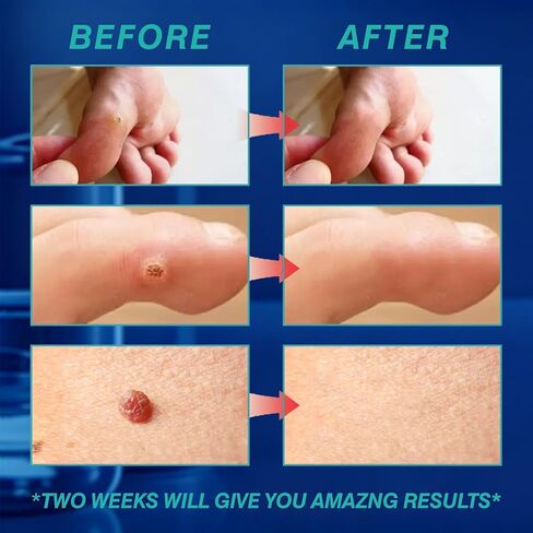Skin Tag Remover, Wart Remover Freeze Off, Fast-Acting Wart & Skin Tag Removal, with Salicylic Acid Maximum Strength, Gentle and Painless, Easy Action, Safe for Sensitive Skin in Saudi Arabia