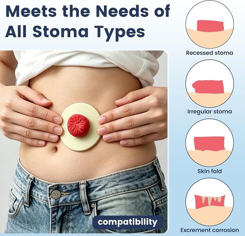 50 PCS 4mm Ostomy Barrier Rings, Medical Hydrocolloid Colostomy Supplies, Moldable Barrier Rings for Ostomy Bag, Suitable for Colostomy, Ileostomy and Urostomy, Skin-Friendly, Leak-Proof Seal in Saudi Arabia