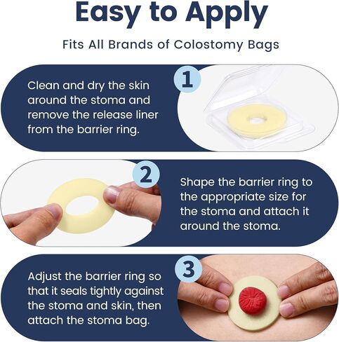50 PCS 4mm Ostomy Barrier Rings, Medical Hydrocolloid Colostomy Supplies, Moldable Barrier Rings for Ostomy Bag, Suitable for Colostomy, Ileostomy and Urostomy, Skin-Friendly, Leak-Proof Seal in Saudi Arabia