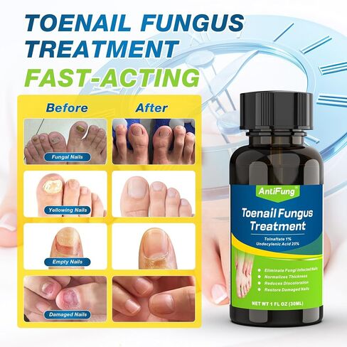 Toenail Fungus Treatment Extra Strength – Maximum OTC with 25% Undecylenic Acid – for Thick, Nail Strengthener and Growth, for Broken, Discolored Nail & Ingrown Toenail, 30ml in Saudi Arabia