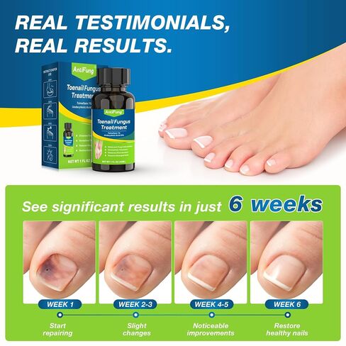 Toenail Fungus Treatment Extra Strength – Maximum OTC with 25% Undecylenic Acid – for Thick, Nail Strengthener and Growth, for Broken, Discolored Nail & Ingrown Toenail, 30ml in Saudi Arabia
