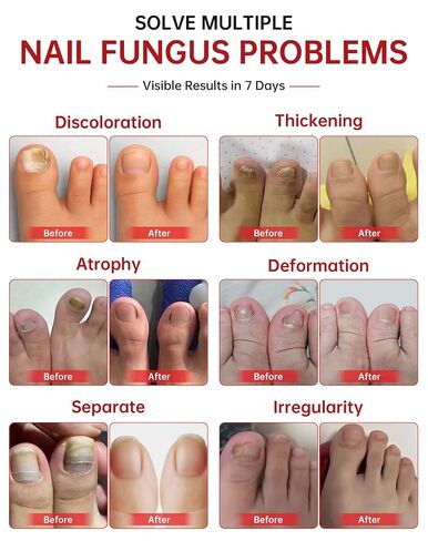 Toenail Fungus Treatment Extra Strength - 25% Undecylenic Acid, Gentle Plant-Based Formula for Damaged & Discolored Nails, Effective Treatment Under & Around Nails, Suitable, 1.01Fl. oz in Kuwait
