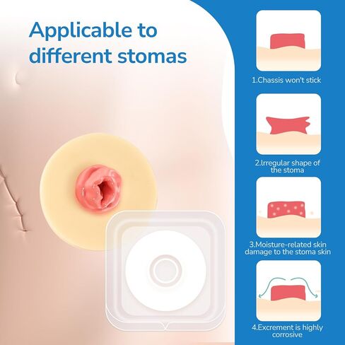 10 PCS Ostomy Barrier Rings, Ostomy Supplies, 2 mm Thickness Moldable Ostomy Rings Medical Grade Hydrocolloid Adhesive Barrier Rings Better Seal for Ostomy Bags (Box of 10) in Kuwait