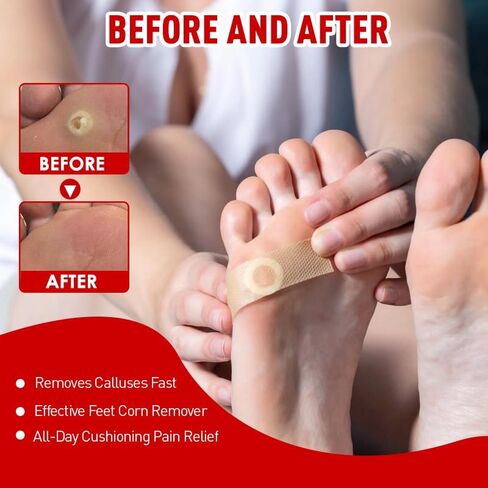 Corn and Callus Remover for Toes and Feet - Extra Strength 40% Salicylic Acid Nursing Pads-Formulated With a Safe Formula to Effectively Remove Corns and Calluses（42 Pack） in Kuwait