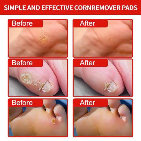 Corn and Callus Remover for Toes and Feet - Extra Strength 40% Salicylic Acid Nursing Pads-Formulated With a Safe Formula to Effectively Remove Corns and Calluses（42 Pack） in Kuwait