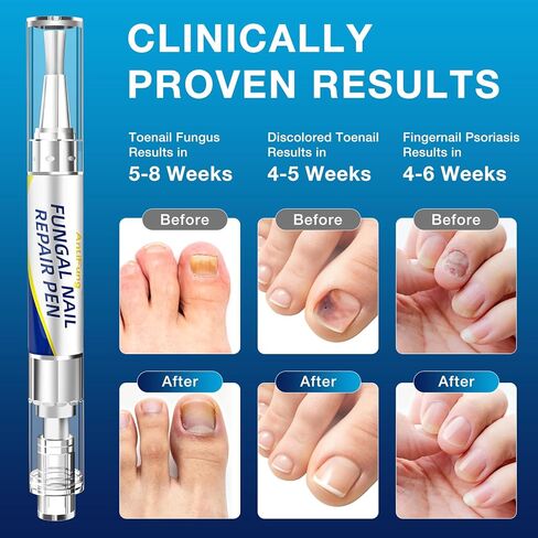 Toenail Fungus Treatment Extra Strength - AntiFung Pen - Maximum OTC with 25% Undecylenic Acid - for Damaged Nails, Ingrown Nails & Discoloration - 3-Pack Applicator Pen in Saudi Arabia