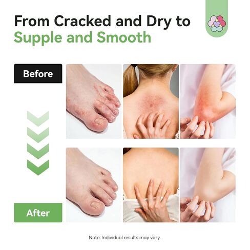 SAVILAND Antifungal Cream FSA-HSA Max Strength: 25% Undecylenic Acid Anti Fungal Cream for Skin Athletes Foot Jock Itch Ringworm Foot Fungus Treatment Comfort with Tea Tree & Oregano Oil 4.23 oz in Kuwait