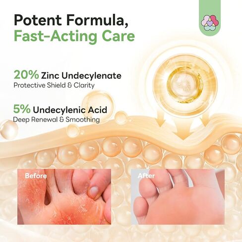 SAVILAND Antifungal Cream FSA-HSA Max Strength: 25% Undecylenic Acid Anti Fungal Cream for Skin Athletes Foot Jock Itch Ringworm Foot Fungus Treatment Comfort with Tea Tree & Oregano Oil 4.23 oz in Kuwait