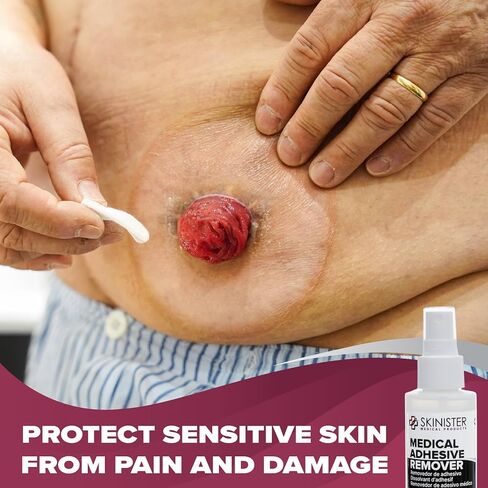 Skinister Adhesive Remover for Skin, 2 Pack – 4oz Each (8oz Total) – Silicone-Based, Hypoallergenic, Sting-Free – for Wig, Ostomy, Tape & Bandage Adhesive Removal in Saudi Arabia