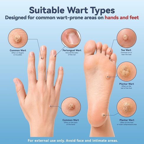 17% Salicylic Acid Wart Remover – Gentle OTC with Natural Plant Extracts, Fast-Acting Effectively Removes for Common Warts and Plantar Warts with Precision applicator & 12 Waterproof Patches in Kuwait