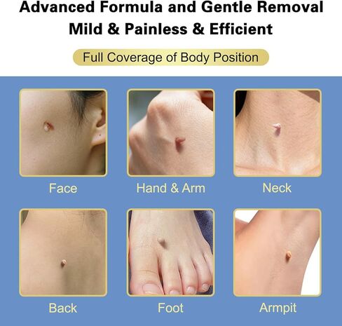 Fast-Acting Skin Tag Remover with Salicylic Acid, with a Precision Brush, Natural & Advanced Formula, Mild & Non irritating, Suitable for All Skin Types, Efficiently & Painless Remover Tags, 30ml in Saudi Arabia