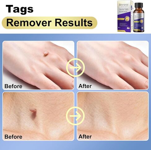 Fast-Acting Skin Tag Remover with Salicylic Acid, with a Precision Brush, Natural & Advanced Formula, Mild & Non irritating, Suitable for All Skin Types, Efficiently & Painless Remover Tags, 30ml in Saudi Arabia