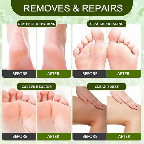 Foot Callus Remover Gel Kit Foot Files Set Heell Exfoliator Dead Skin Remover Pedicure Foot Spa Products Home Pedicure Foot Spa Supplies for Rough, Dry, Cracked Skin in Saudi Arabia