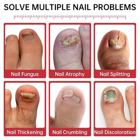 Nail Fungus Treatment Extra Strength – 1% Tolnaftate, Effective Treatment Under and Around Nails, Repairs Damaged Nails, Plant-Based Gentle Formula for Thickened and Discolored Nails, 0.51 fl.oz in Kuwait