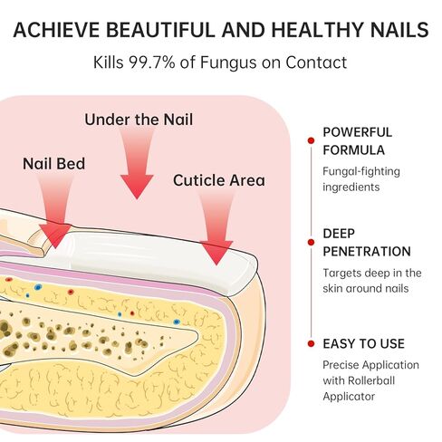 Nail Fungus Treatment Extra Strength – 1% Tolnaftate, Effective Treatment Under and Around Nails, Repairs Damaged Nails, Plant-Based Gentle Formula for Thickened and Discolored Nails, 0.51 fl.oz in Kuwait